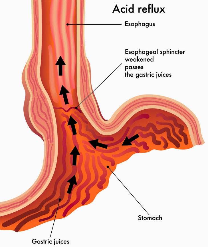 Acid Reflux during pregnancy